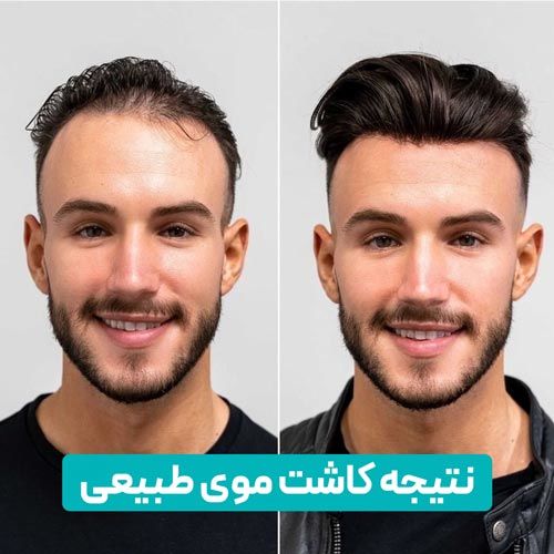 نتیجه نهایی کاشت مو